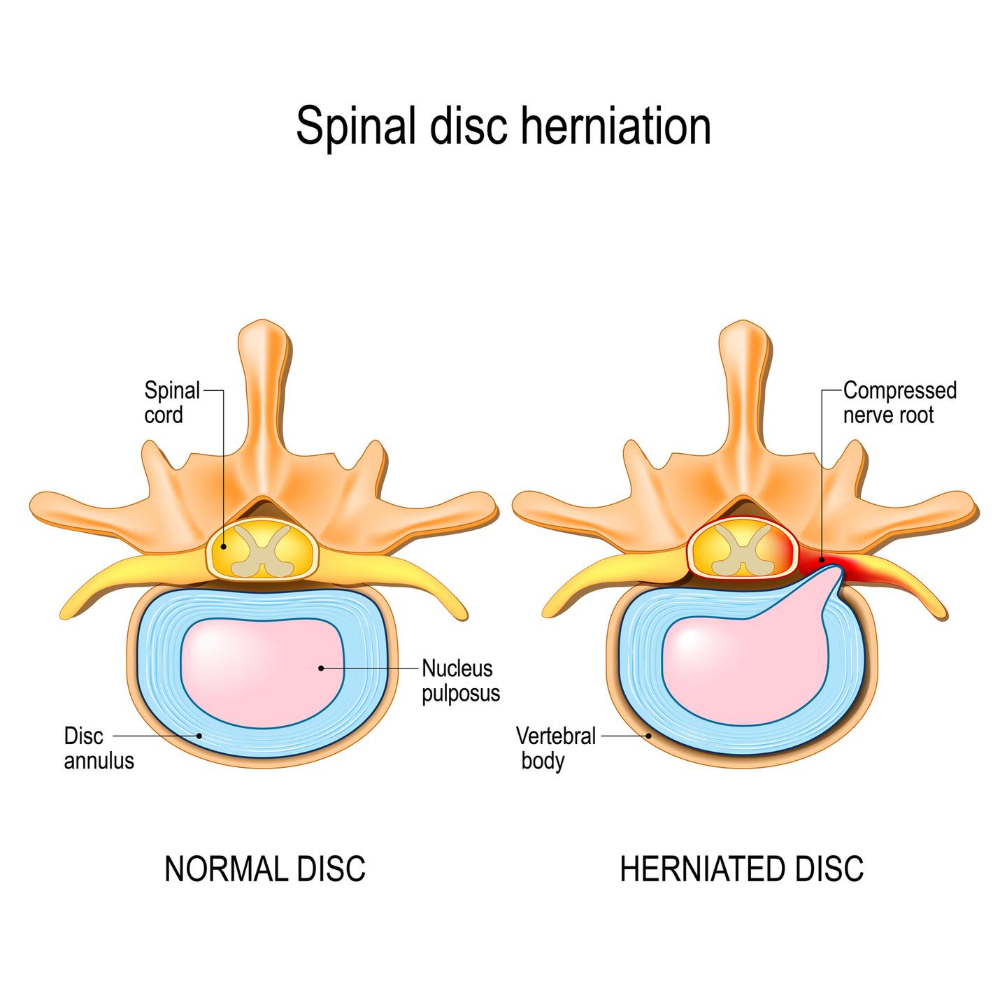 ISSA, International Sports Sciences Association, Certified Personal Trainer, ISSAonline, Personal Trainer's Guide: Exercising After a Herniated Disc